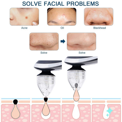 Blackhead Remover, TURATA Pore Cleanser Vacuum Kit (Black)